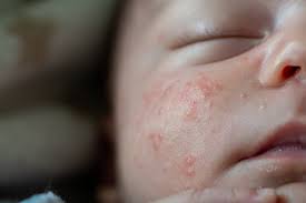 Pediatric Skin Infection Service